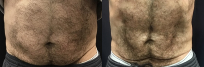 45-54 year old man treated with CoolSculpting - Treatead with Coolsculpting and accoustic wave therapy combination. 100% non-invasive
