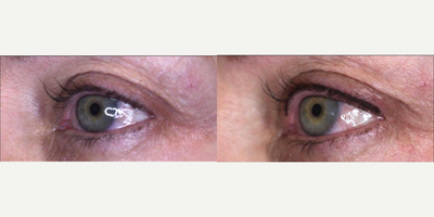  Permanent Makeup by Heidi Carney - Cosmetic tattooing is a procedure that tattoos pigment onto areas of the face that mimics the appearance of makeup. Cosmetic tattoos are used by people who have sensitivity or allergies to traditional cosmetics, people with difficulty seeing, and patients who are unable to apply makeup due to conditions like arthritis or Parkinsons disease. In addition, it is also beneficial for those who do not have facial hair due to allergies, hair pulling, or aging and genetics. After the areas of the face receive cosmetic tattoos, the makeup becomes semi-permanent and will not wash off from water, cleansers, or sweat. Cosmetic Tattooing is usually applied to the eyebrows, upper and lower eyelashes, and the lips.