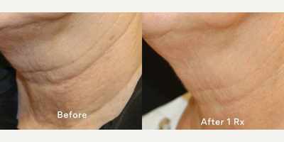 Woman treated with Opus Plasma - Woman treated with Opus Plasma