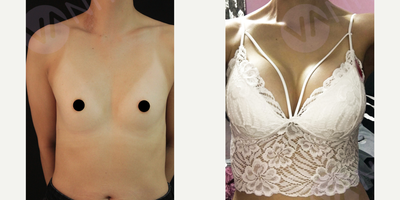 25-34 year old woman treated with Breast Implants, Breast Augmentation - 25-34 year old woman treated with Breast Implants, Breast Augmentation