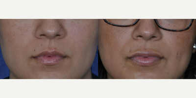 18-24 year old woman treated with Lip Implants - PermaLip Implant