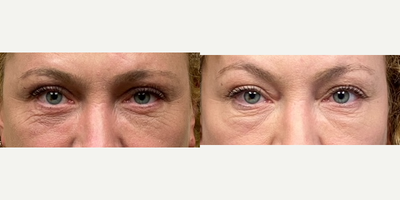 55-64 year old woman treated with Eyelid Surgery - Two months after a lower and upper eyelid lift