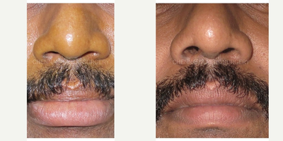 35-44 year old man treated with Lip Reduction - LIP REDUCTION