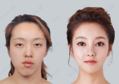 25-34 year old woman treated with V Line Surgery - Orthognatic Surgery + Square Jaw Surgery + High L Cheekbone Reduction + Bambi Eyelid Surgery + Customized Barbie Line Rhinoplasty in ID hospital