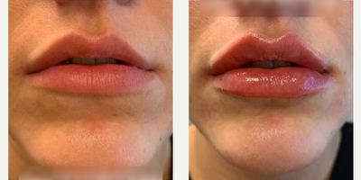 Woman treated with Lip Fillers, Juvederm - Woman treated with Lip Fillers, Juvederm