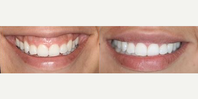 35-44 year old man treated with Lip Lowering - This patient's gummy smile was treated with upper lip lowering so the upper lip appears to be more full.
