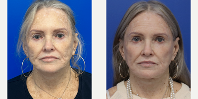 65-74 year old woman treated with CO2 Laser, Dermal Fillers - 74 years old after 1 co2 laser session, and filler tp cheek, laugh line and marionette lines.