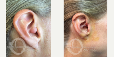 45-54 year old woman treated with Ear Lobe Surgery - cyst removal from ear