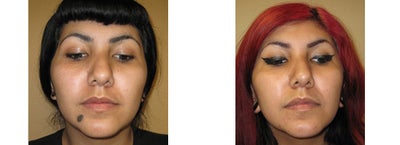 Mole Removal photos - 
	Mole Removal photos
