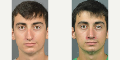 Man treated with Rhinoplasty, Septoplasty - After two broken noses, Dr. Marotta repaired this patient's nose with Inferior Turbinate Reduction, Repair of the Nasovestibular Stenosis, Rhinoplasty and Septoplasty.6 month follow up, these results are amazing.His nasal contour profile is straight, good nasal midline, and he has a natural appearance which compliments his entire facial profile.