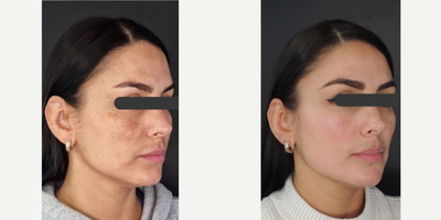 Woman treated with Chemical Peel - Woman treated with Chemical Peel