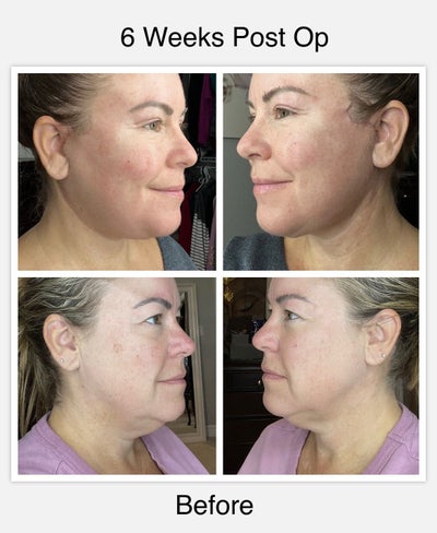Gulf Coast Plastic Surgery - This patient is 6 weeks post-op from