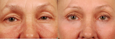 Partial Deep Peel Around the Eyes- Phenol-Croton Oil - 
	This patient was unhappy with the wrinkles around and under her eyes. We treated her with a deep phenol croton-oil peel, that essentially erased all the lines and wrinkles.
