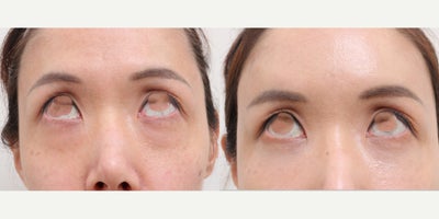 45-54 year old woman treated with Nonsurgical Facelift - To address facial volume loss and soften overall facial lines, a minimally invasive, non-incisional lifting approach using autologous fat transfer was performed.For hollow, tired-looking under-eye areas, a non-incisional fat repositioning technique was used to restore volume and improve the transition