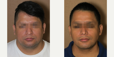 Man treated with Rhinoplasty - Man treated with Rhinoplasty (nose job), cheek fat pad removal (buccal fat excision), neck lift with liposuction of the neck