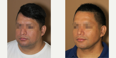Man treated with Rhinoplasty - Man treated with Rhinoplasty (nose job), cheek fat pad removal (buccal fat excision), neck lift with liposuction of the neck