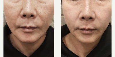 45-54 year old woman treated with Radiesse, Juvederm - Before and after images show patients aged 3055 who underwent advanced lifting treatments such as Titanium Lifting, Ultherapy, and Thermage. These procedures are designed to improve skin firmness, refine facial contours, and support collagen regeneration, helping achieve naturally lifted and balanced results tailored to each patients skin condition
