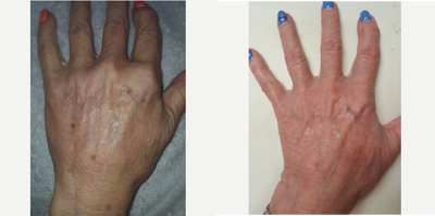 65-74 year old woman treated with PicoWay - 65-74 year old woman treated with PicoWay for brown spots/age spots on hands