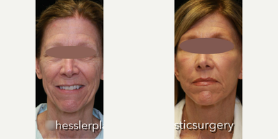 Woman treated with Laser Resurfacing - Woman treated with Deep Plane Facelift, Neck Lift, Lip Lift, Facial Fat Transfer, and Laser Resurfacing. Pre-op, patient was concerned about her face looking tired and she didn't feel the same.