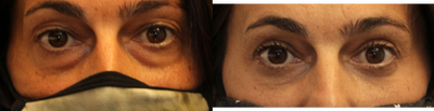 Blepharoplasty for eye bags - Dr. Kotlus combined fat grafting, transconjunctival blepharoplasty, and skin resurfacing to eliminate lower eyelid bags.