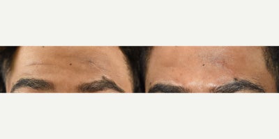 Fractional laser resurfacing for scar removal in a dark skin patient. - For anyone that says you can't treat black skin with lasers, we say.... maybe you can't but it's our specialty.