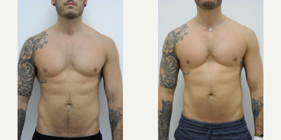 25-34 year old man treated with Pec Implants - 31 year old male 3 months after pectoral implants performed by Dr Sam Gershenbaum.He had Implantec vertical rectangular soft solid silicone pec implants placed under the muscle. This patient requested a very natural appearing result that primarily enhanced his upper chest. He looks un-operated and completely natural with results exactly as requested.