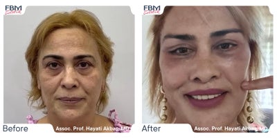 55-64 year old woman treated with Facelift, Facial Fat Transfer, Deep Plane Facelift, Eyelid Surgery - 55-64 year old woman treated with Facelift, Facial Fat Transfer, Deep Plane Facelift, Eyelid Surgery
