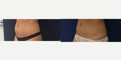 25-34 year old woman treated with CoolSculpting - Before and after CoolSculpting of the upper, lower abdomen and flanks (1 treatment, 4 cycles/areas)