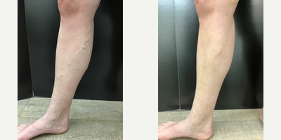 35-44 year old woman treated with Radiofrequency ablations, Varithena, and Sclerotherapy - The one month results after treatment of Radiofrequency Ablations, Varithena, and Sclerotherapy. The results came out great!