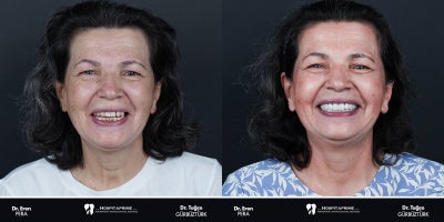 55-64 year old woman treated with Dental Implants, Dental Crown - Looking for cost-effective and advanced dental implant solutions? Dental implants in Turkey are a popular choice for restoring missing teeth. Using the all-on-4 or all-on-6 techniques, full arches can be replaced with 4 or 6 implants, eliminating the need for bone grafts in many cases.These methods offer faster recovery, excellent stability, and natural aesthetics. Plus, with competitive dental implant prices, Turkey has become a top destination for high-quality dental care.Start your journey to a confident smile today with innovative and affordable treatments.