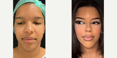 Woman treated with African American Rhinoplasty - Our patient shared these photos with us, looking absolutely radiant and exuding confidence and elegance. Just 2 months post-op from a bridge augmentation, its wonderful to see how well shes healing.A streamlined profile can be truly transformative, changing not only your appearance but also how you perceive yourself.Her elegant look and stunning makeup truly highlight her incredible transformation.What do you think of this change? Could this be something youd love for yourself?