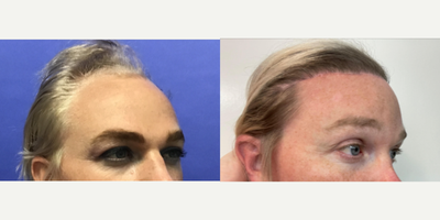 35-44 year old transgender woman treated with Brow Lift, Hair Loss Treatment, TCA Peel - 35 to 44 year-old female patient is 3 months post-op from Tissue Expander Removal and Flap Rotation and 1 year post-op from Facial Feminization surgery. Her procedures included: Placement of Tissue Expander, Forehead Lift and Orbital Bony Contouring, Septorhinoplasty (closed) with Cartilage Grafts and Weirs, Cheek Implants (small), Chin Reduction and Contour, Subnasal Lip Lift with Fat Augmentation to Lips, Medium Facelift, 1cc of Voluma Juvederm, Periorbital TCA Peel and Removal of two moles on face, Remove Tissue Expander and Rotate Flap.