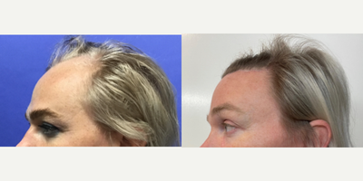 35-44 year old transgender woman treated with Brow Lift, Hair Loss Treatment, TCA Peel - 35 to 44 year-old female patient is 3 months post-op from Tissue Expander Removal and Flap Rotation and 1 year post-op from Facial Feminization surgery. Her procedures included: Placement of Tissue Expander, Forehead Lift and Orbital Bony Contouring, Septorhinoplasty (closed) with Cartilage Grafts and Weirs, Cheek Implants (small), Chin Reduction and Contour, Subnasal Lip Lift with Fat Augmentation to Lips, Medium Facelift, 1cc of Voluma Juvederm, Periorbital TCA Peel and Removal of two moles on face, Remove Tissue Expander and Rotate Flap.