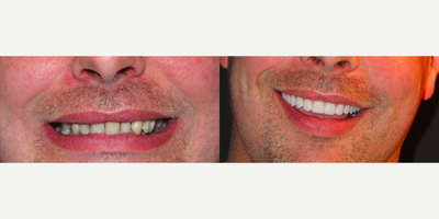 All-on-4 Dental Implants - All-on-4 Dental Implants