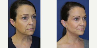 47 year old woman treated with facelift, blepharoplasties, and fat grafts to face - 47 year-old female seen 8 months after upper and lower blepharoplasties, facelift, and fat grafts from abdomen to face.