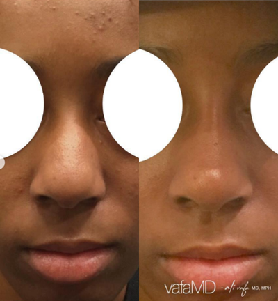 18-24 year old woman treated with Nonsurgical Nose Job - WHAT IT DOES: Straighten or define the bridge of the nose +/- augment and or lift the tipPRODUCT: Radiesse, Voluma, Restylane Lyft (Perlane)TECHNIQUE: Multi micro-droplet and Linear threading injection techniques