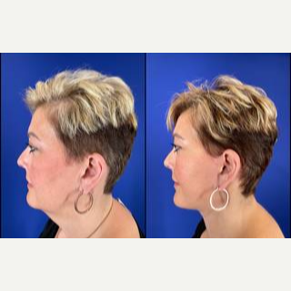 45-54 year old woman treated with Facelift - Facelift