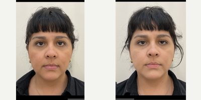 35-44 year old woman treated with Restylane Lyft, Restylane - Under eye filler