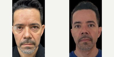 Man treated with Eyelid Surgery, Facial Fat Transfer - Man treated with Eyelid Surgery, Facial Fat Transfer