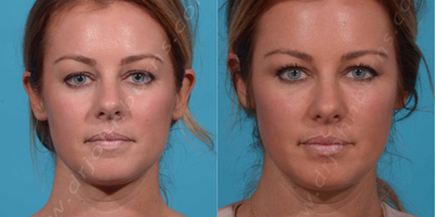 25-34 year old woman treated with Radiesse - Radiesse Face: 3 Syringes to temples, cheeks, nasolabial folds, marionette lines, chin and jaw