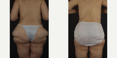 55-64 year old woman treated with Accent Laser - 63 year old treated with liposuction and accent laser (JuVashape) for skin tightening