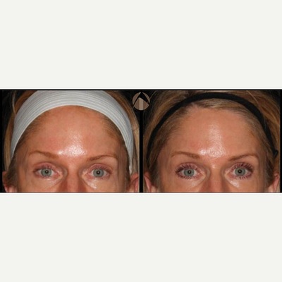 Woman treated with CO2 Laser - CO2RE, Fractional CO2 Resurfacing treatment