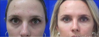 Woman treated with Liquid Facelift - This patient had severe hollowing in the under eye area. Dr. Barbarino injected her tear troughs with Belotero to restore a more rested and youthful appearance.