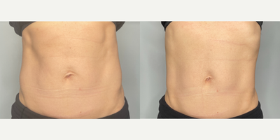 18-24 year old woman treated with Emsculpt - results after 2 emsculpt neo treatments