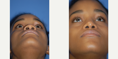 25-34 year old woman treated with Rhinoplasty - Base view shows smaller nostrils and a less rounded tip.