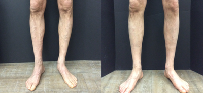 55-64 year old man treated with Vein Treatment - Before and after vein treatment