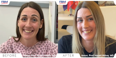 35-44 year old woman treated with Deep Plane Facelift - She came 4 months ago to the doctor and said: I look much older than my real age and if possible, I want to look younger so that at least I show my real age. I have gained weight and lost it, which makes me look old and sad. She had surgery and spentone month,her husband couldn't recognize her. He was surprised by the change that she had.She liked the result herself and her recovery will continue for one year.