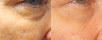 ePrime and CO2RE treatment on 64 year old Female - Patient treated with ePrime Energy-Based Dermal Remodeling to improve skin tone and volume and CO2RE Fractional CO2 Resurfacing System to treat tone, texture, sun damage, and age spots. After photo shows 2-months post-procedure. Effects of ePrime are expected to continue to improve skin tone and volume over the next 4 months by creating new collagen and elastin in the skin.