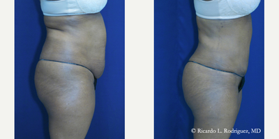 45-54 year old woman treated with Tummy Tuck - (50s YO) This 59 year old female had a Brazilian Butt Lift with 545 cc of fat injected into each buttock cheek to give her more prominent buttocks and a more shapely body.