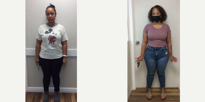 25-34 year old woman treated with Orbera Gastric Balloon - Weight prior to procedure: 202 lbs., BMI 34.7Weight post-procedure: 185.3 lbs., BMI 31.8Weight loss to date of 16.7lbs, representing % total body weight loss (TBWL), at 3 months.